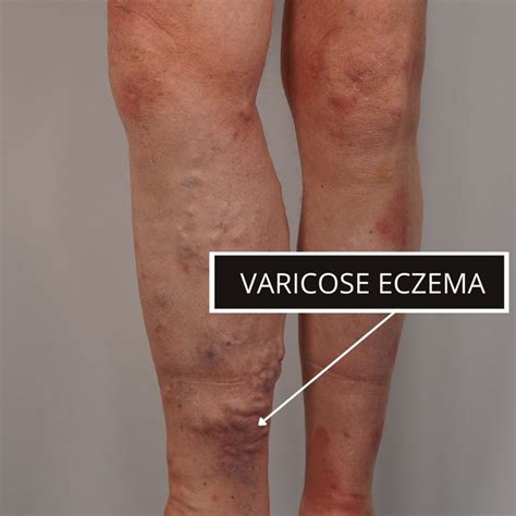 tratamentul eczemei ​​varicoase a limfostazei
